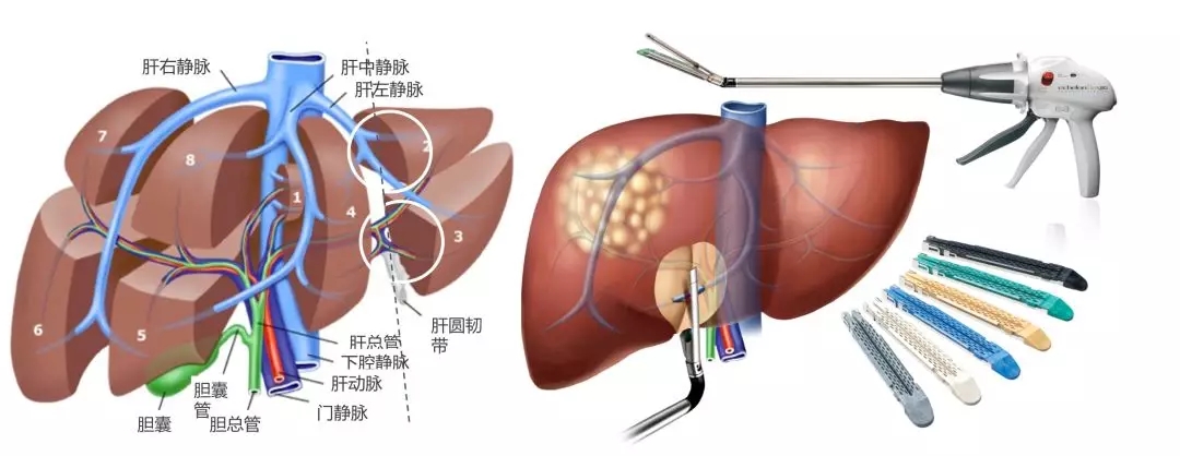 切除适宜性与疗效