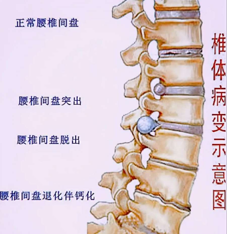 腰椎间盘突出症急性发作后恢复指南 3个关键注意事项 (腰椎间盘突出最好的治疗方法)
