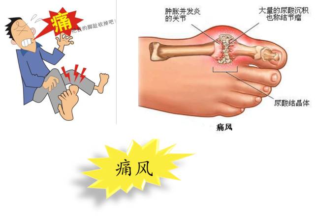 血尿酸不高 风湿病宣传周 为何仍会被诊断为痛风 (血尿酸不高风险正常吗)
